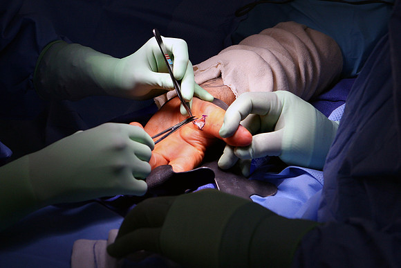 Bhatt Hand Surgery