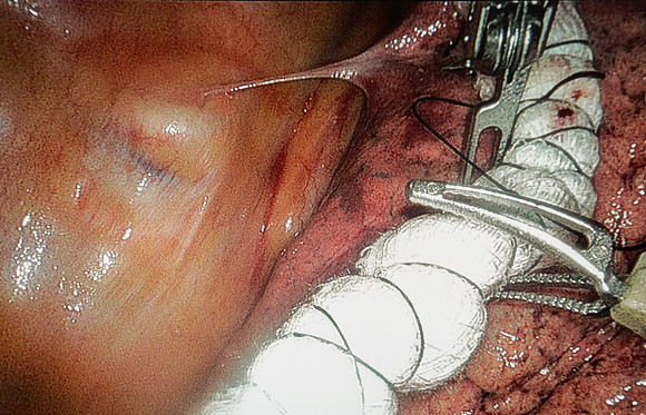 abbas-davinci-surgery-
